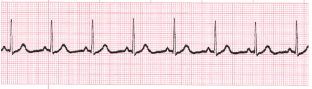<p><strong>Normal Sinus Rhythm</strong></p><p>-Rate, rhythm, intervals, and morphology are _______</p><p>-Rate = __-___ BPM</p><p>-Rhythm = regular</p><p>-Intervals = less than 3 small boxes</p>