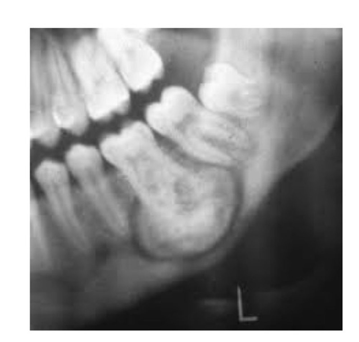 <p>A type of mesenchymal odontogenic tumour. A cementum-producing lesion. Radiographically: a well defined radiopaque mass with a surrounding radiolucent halo. Tx: enucleation (removal) of the tumour and removal of the involved tooth, does not recur.</p>
