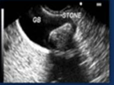 <p>Echogenicity of this </p>