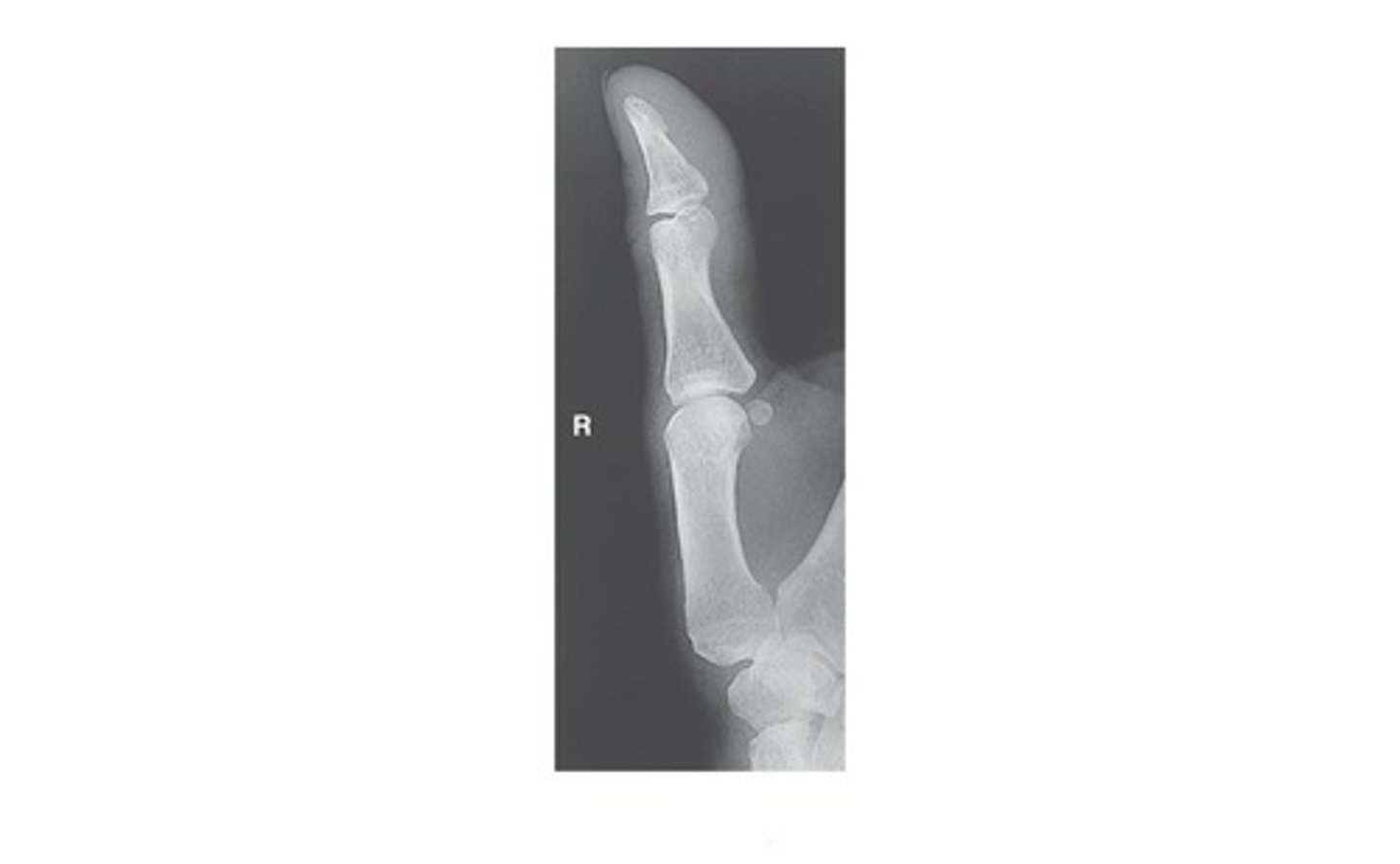 <p>b. Oblique Thumb</p>