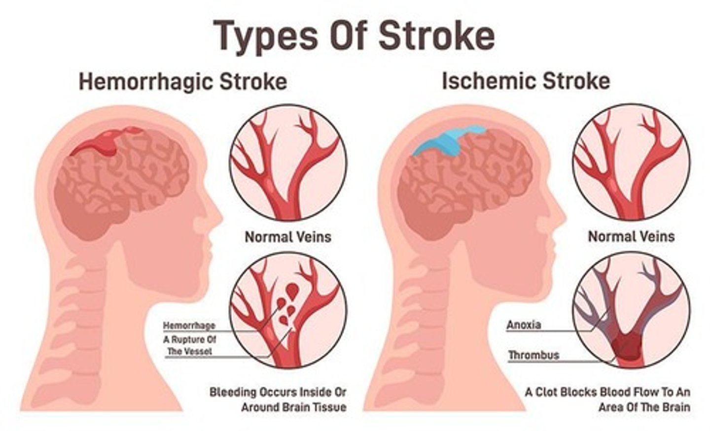 <p>Occurs when a clot blocks or impairs blood flow, depriving the brain of essential oxygen and nutrients</p><p>blood flow obstructed</p>