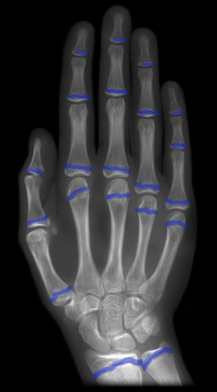 <p><span><span>Highlighted in blue are epiphyseal plates. Which of the following statements is </span></span><strong>true </strong><span><span>regarding the</span></span><strong> </strong><span><span>highlighted structures?</span></span></p>
