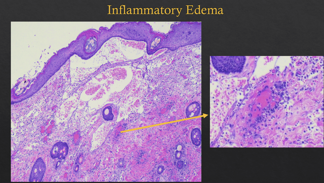 <p>high protein levels</p><p>related to increased vascular/endothelial permeability</p><p>caused by leakage of plasma proteins = albumin and leukocytes</p><p>cloudy to opaque</p>