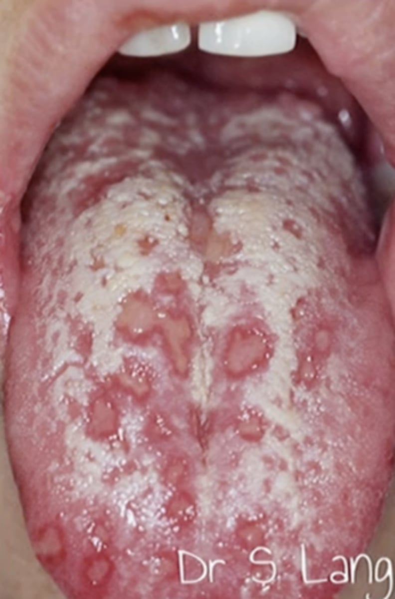 <p>Hint: occurs in young children on mouth/lips</p>