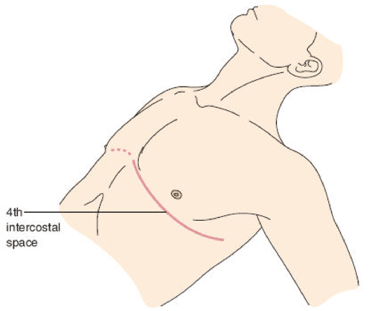<p>From Sternal Edge To Midaxillary</p><p>At Level Of 4th or 5th Intercostal Space</p>