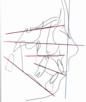 <p>-skeletal pattern that deviates from the norm in that there is an excessive divergence of the skeletal planes (determined by the analysis used)</p><p>-characterized by a steep mandibular plane angle, a long anterior lower face height with open bite tendency, lip incompetence, and often associated with class II malocclusion</p>