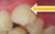 <p>tooth position toward lip </p>
