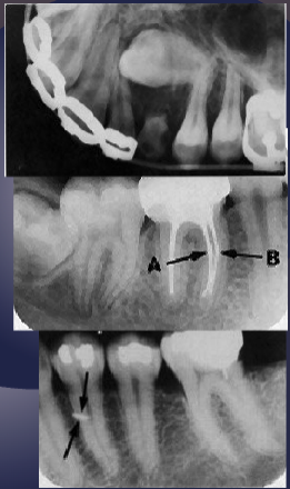 <ul><li><p>impacted/supernumerary tooth</p></li><li><p>root canal</p></li><li><p>foreign bodies</p></li><li><p>fractures</p></li></ul><p></p>