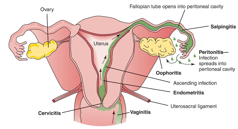 <p> <strong><em>Endometrial thickening or fluid may indicate _______________ ?</em></strong></p><p> <strong><em>………… is an infection within endometrium of the uterus.</em></strong></p><p class="p1"> It occurs most often in association with PID, in postpartum state, or following</p><p class="p1">instrumentation of uterus.</p><p class="p1"> In patients with pelvic infection, uterus is conduit for infectious spread to tubes and</p><p class="p1">adnexa.</p><p class="p1"> Postpartum patients may develop endometritis after prolonged labor, vaginitis,</p><p class="p1">premature rupture of the membranes, or retained products of conception.</p><p class="p1"> Clinically, <strong><em>patient has intense pelvic pain</em></strong>.</p><p class="p1"> Sonographically, the <strong><em>endometrium appears prominent, irregular, or both</em></strong>, with a</p><p class="p1">small amount of <strong><em>endometrial fluid.</em></strong></p><p class="p1"> <strong><em>Pus may be demonstrated in the cul-de-sac as echogenic particles or debris</em></strong>.</p><p class="p1"> <strong><em>Enlarged ovaries with multiple cysts </em></strong>and indistinct margins may be seen secondary</p><p class="p1">to periovarian inflammation.</p><p class="p1"> <strong><em>Dilation of the fallopian tube shows fluid-filled tubular shapes in a folded</em></strong></p><p class="p1"><strong><em>configuration and well-defined echogenic walls.</em></strong></p><p class="p1"> A thickened tubal wall (5 mm or more) indicates acute disease. These should be</p><p class="p1">distinguished from a fluid-filled bowel by gentle compression on the pelvic wall to</p><p class="p1">look for peristalsis or movement in the bowel lumen.</p><p class="p1">Sonographic findings</p><p class="p2"> Endometrium may appear thick, contain fluid, air or clot or appear</p><p class="p2">normal.</p><p class="p2"> <strong><em>Endometrium considered normal up to 20 mm.</em></strong></p><p class="p2"> <em>Measurement of &gt;20 mm should raise suspicion of endometritis,</em></p><p class="p2"><em>hemorrhage, or retained products of conception</em>.</p><p class="p2"> <strong>Risk for endometritis <em>increases</em> with premature rupture of</strong></p><p class="p2"><strong>membranes, retained clot or POCs and prolonged labor.</strong></p><p class="p2"> As the <strong><em>infection worsens</em></strong>, <strong><em>periovarian adhesions </em></strong>may form and fuse the inflamed tube and</p><p class="p1">ovary, called the <strong><em>tubo-ovarian complex</em></strong>.</p><p class="p1"> Further progression results in a tubo-ovarian abscess that appears as a complex</p><p class="p1">multiloculated mass with septations, irregular shaggy margins, and scattered internal echoes.</p><p class="p1"> There can be posterior enhancement and a fluid-debris level. Gas bubbles are present in rare</p><p class="p1">cases; however, these also are observed in normal postpartum patients.</p><p class="p1"> In the immediate postpartum period, the presence of retained tissue is difficult to distinguish</p><p class="p1">from inflammatory debris or blood clots.</p><p class="p1"> The sonographic appearance can be similar to that of other adnexal masses, so clinical</p><p class="p1">correlation is important.</p><p class="p1"> Sonography can also be useful in following the response to antibiotic therapy or in guided</p><p class="p1">transvaginal aspirations and drainage. If the aspirate is purulent, catheter drainage is used.</p>