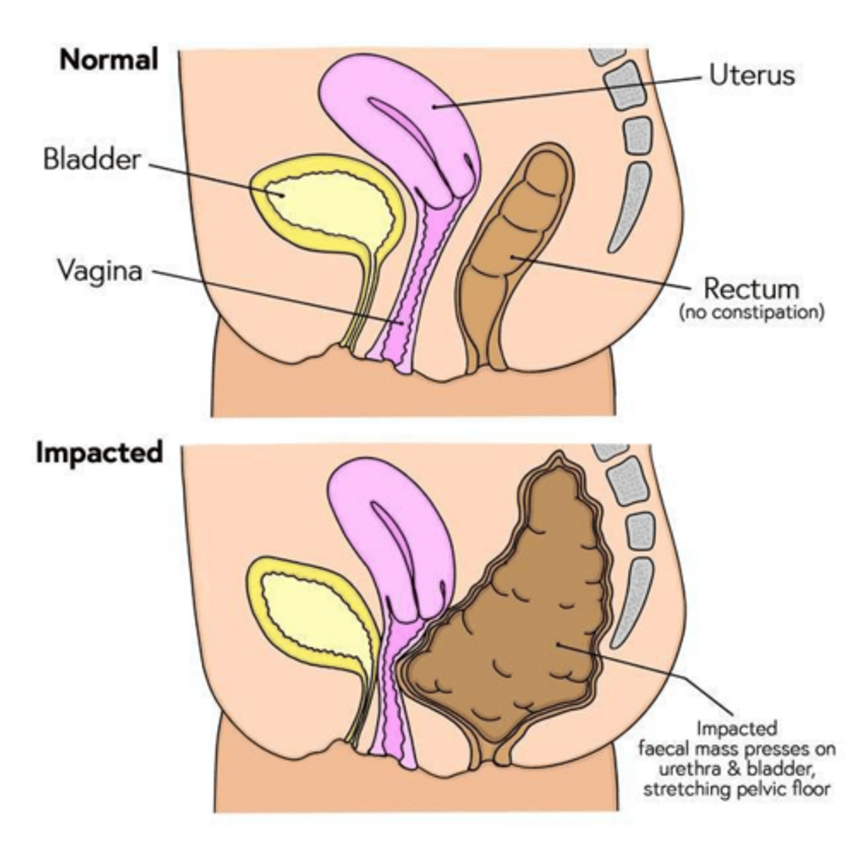 <p>≥2 of: <3 BM/week, straining, lumpy/hard stools, incomplete evacuation, or blockage feeling.</p>