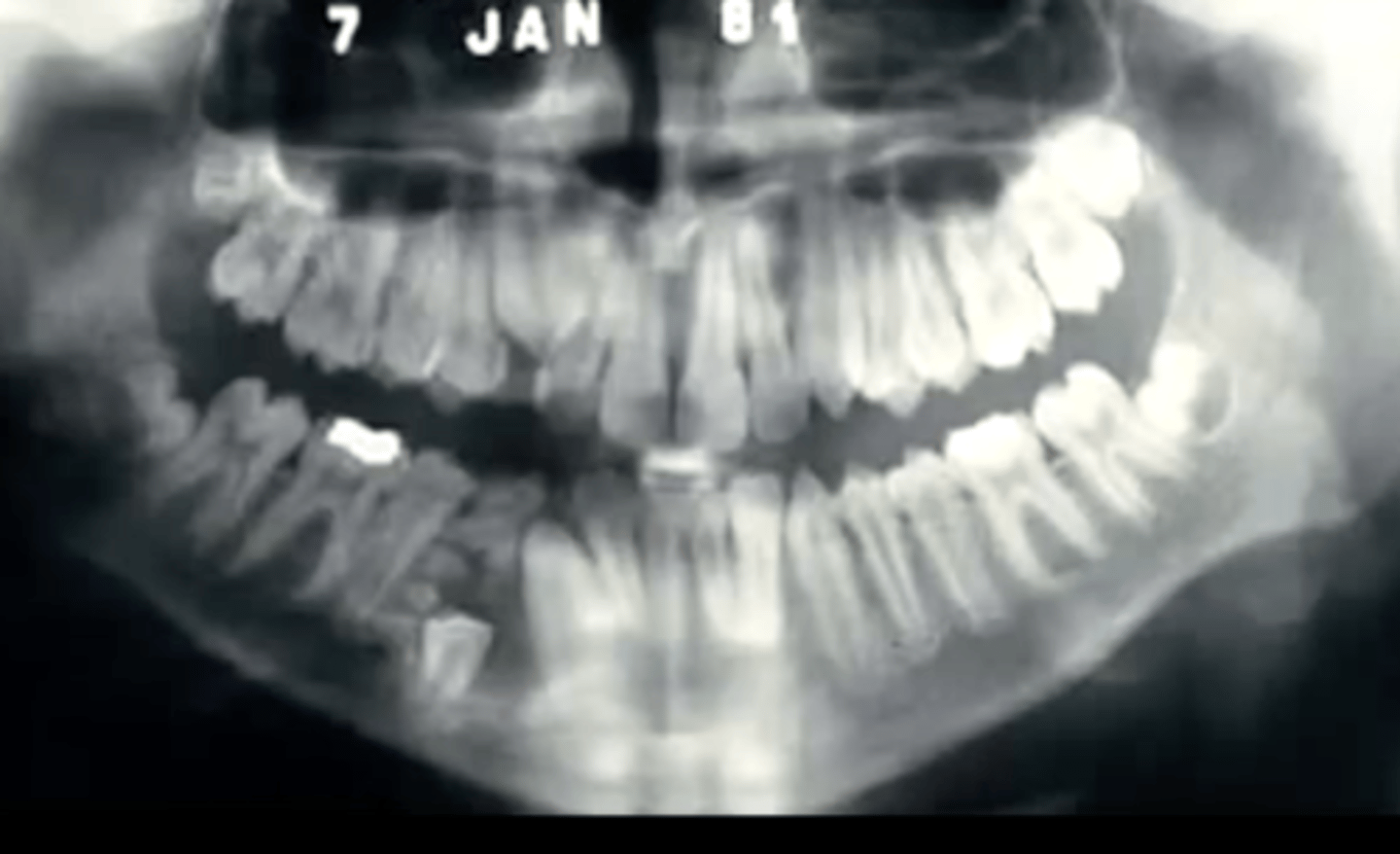 <p>combination of ameloblastic fibroma and odontoma, presents as a circumscribed radiolucency that contains "spiky" radiopacities </p>