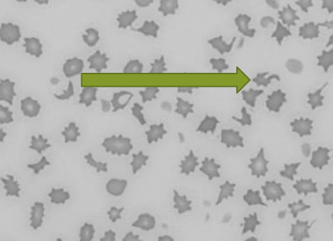 <ul><li><p>abnormally shaped RBC’s</p></li><li><p>does not suggest specific dx or cause for change</p></li><li><p>term used only when abnormalities cannot be described by another term </p></li></ul><p></p>