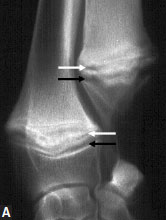 <p>History of acute lameness, fever, increased WBCs</p><p>X-ray (double physeal line, secondary extraperiosteal proliferation, calcification along the metaphysis)</p>