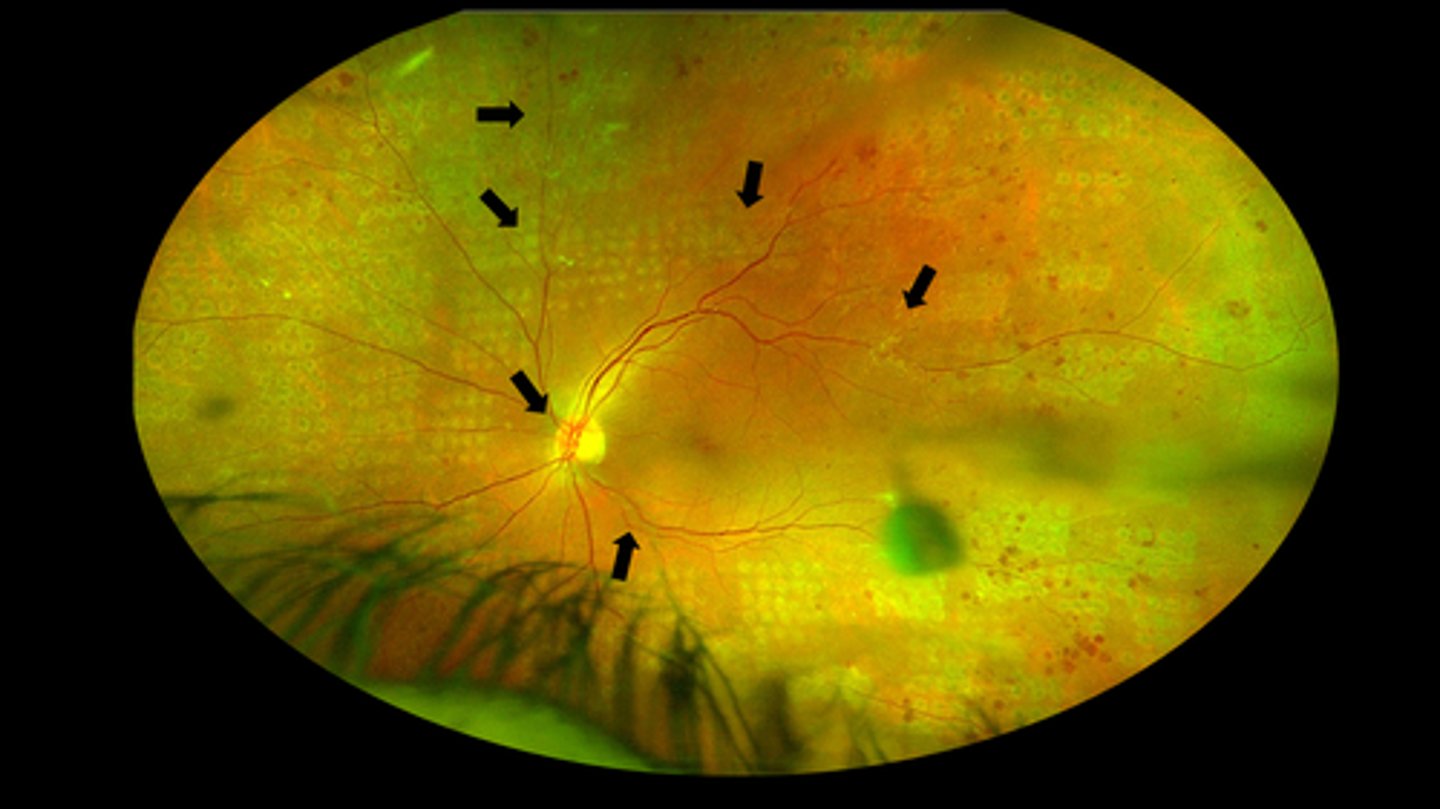 <p>What did PANORAMA suggest about anti-VEGF for DR?</p>