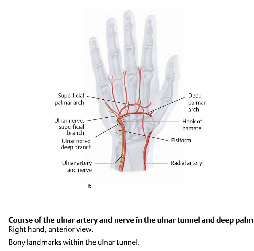 <p><span>•Pain in ulnar hand</span></p><p><span>•Weak hypothenar muscles</span></p><p><span>•Sensory loss at small and ½ ring finger</span></p>
