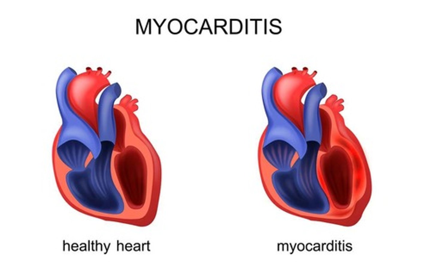 <p>Inflammation of the myocardium—the muscular walls of the heart.</p>