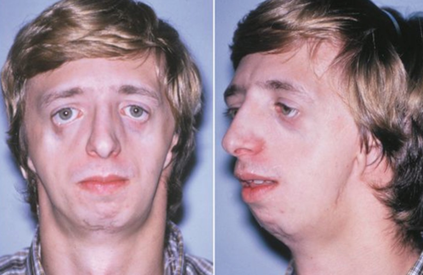 <p>Treacher collins - auto dom mutation on chrom 5</p>