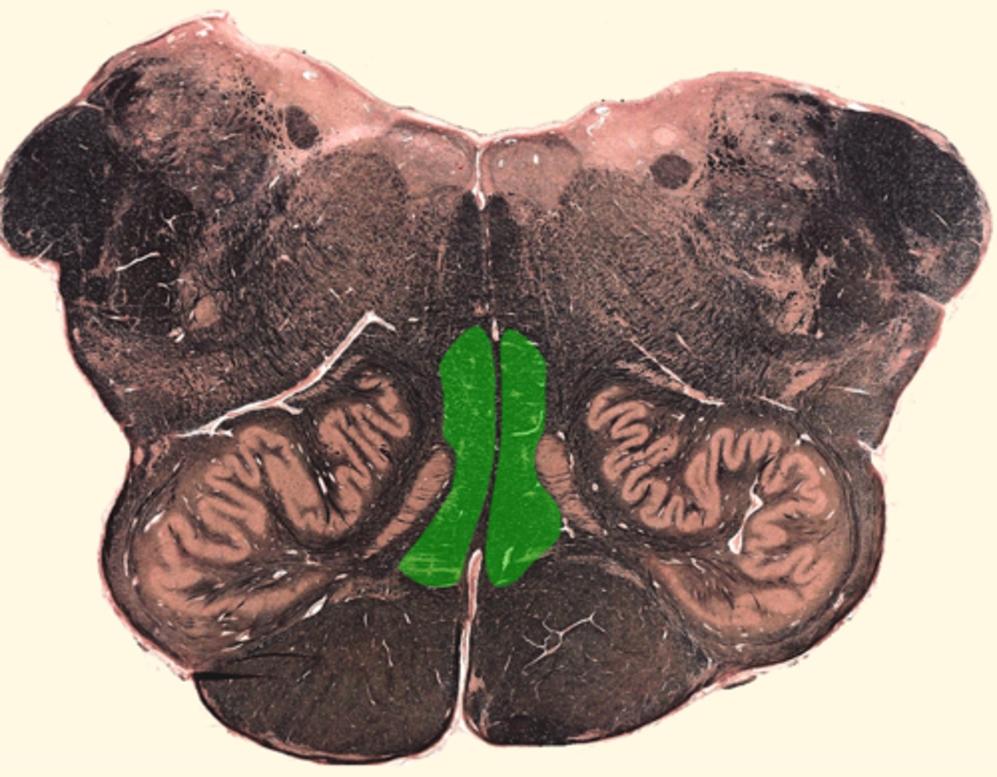 <p>The somatosensory pathway between the dorsal column nuclei and the ventral posterior nucleus of the thalamus.</p>