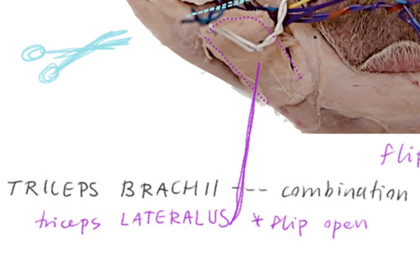 <p>A flap on the arm that reveals the hidden medial head</p>