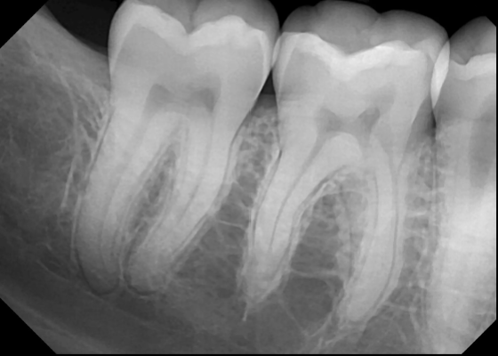<ul><li><p><strong>Normal Anatomy</strong></p><ul><li><p><strong>Mylohyoid Ridge</strong></p></li><li><p><strong>SubMn Fossa</strong></p></li></ul></li></ul><p></p>
