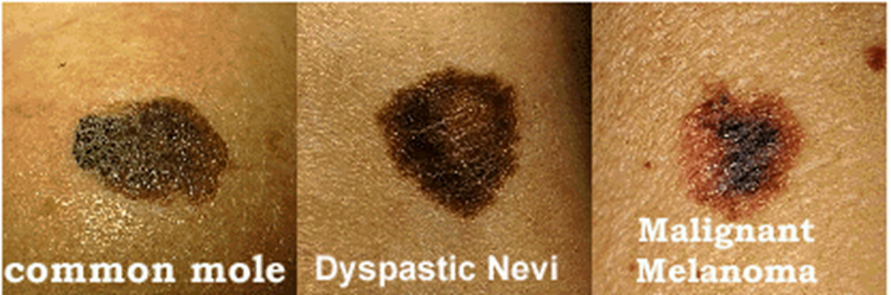 <p>colour for melanoma</p>
