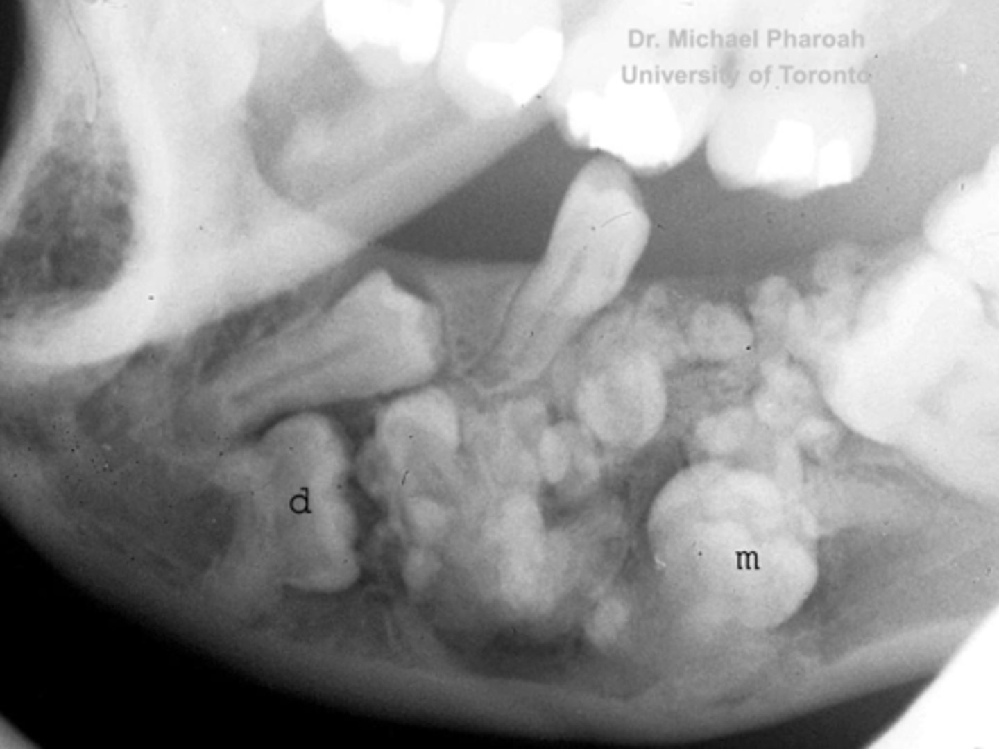 <p>14 year old patient presents with all teeth erupted except for the 1st molar. Radiograph shows a collection of tooth-like structures surrounded by radiolucent zone. What is the pathology?</p>