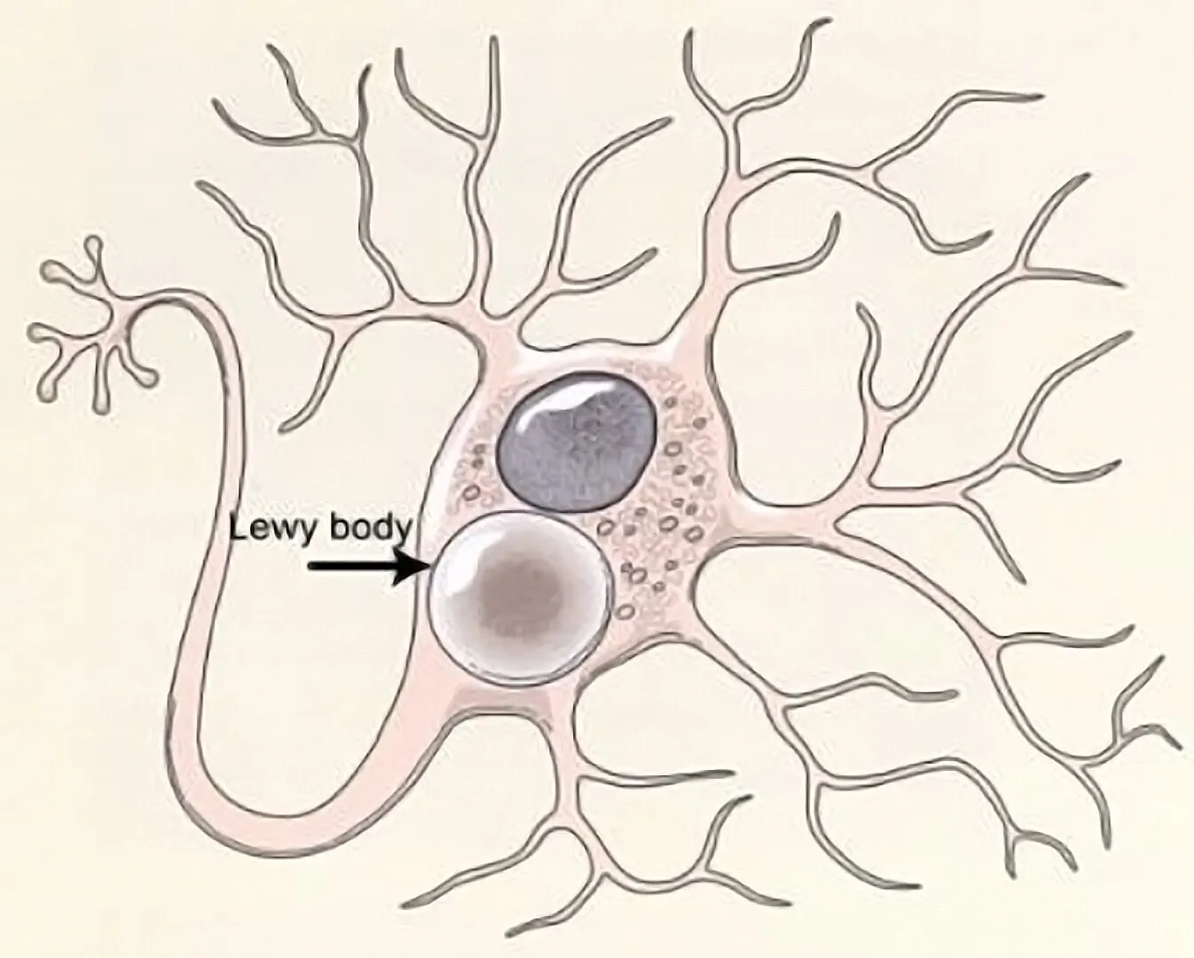 <p>Lewy bodies</p>