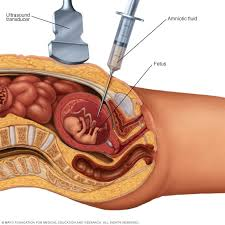 <p>→ A thin needle is inserted into the amniotic sac through the abdominal wall under ultrasound guidance.</p><p>→ A small amount of amniotic fluid is withdrawn — this fluid contains fetal cells and proteins.</p><p>→ These cells are cultured and analyzed for chromosomal abnormalities, genetic mutations, and biochemical markers.</p><p></p>