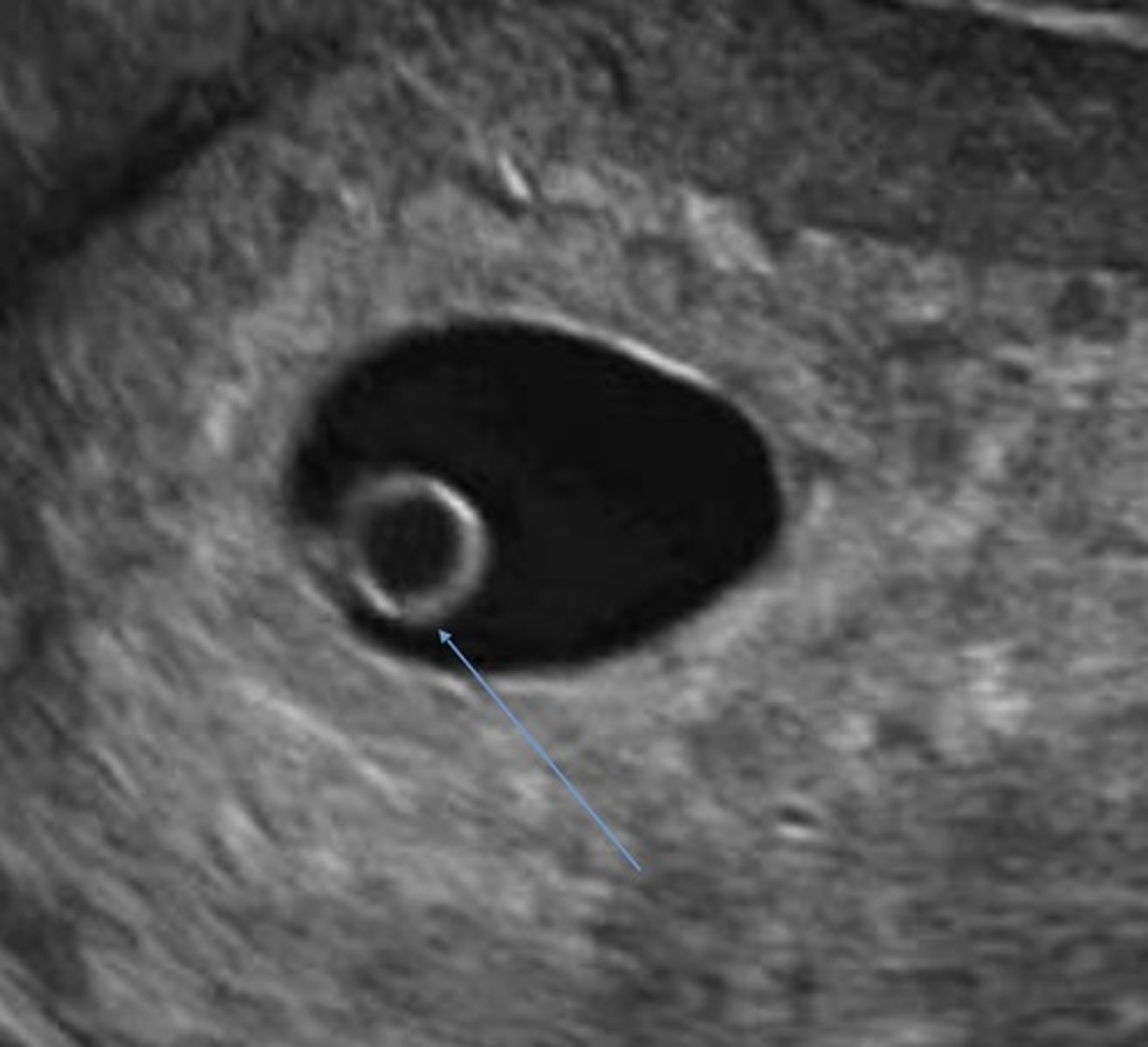 <p>Needed to confirm pregnancy</p><p>Round + smooth walls</p><p>Located between amnionic and chorionic membranes</p>