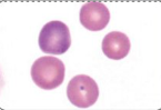 <p>Name the dark poikilocyte. What causes it?</p>