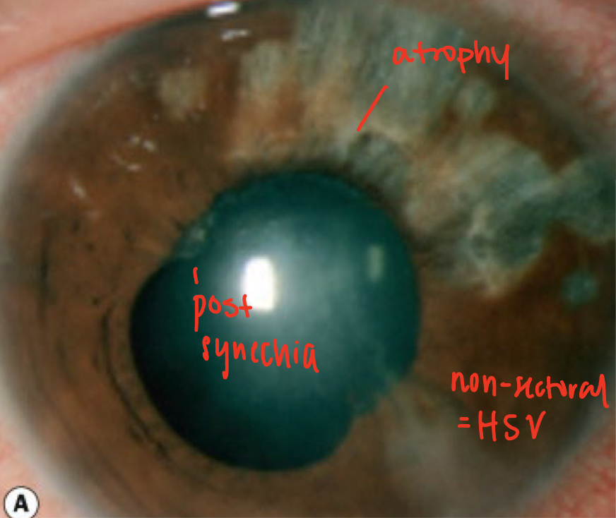 <ul><li><p>causes 8% of uveitis cases</p></li><li><p><span><span>The clinic course can be acute, chronic or recurrent</span></span></p></li><li><p><span><em><span>Granulomatous</span></em></span></p></li><li><p><span><span>Can cause anterior or posterior uveitis</span></span></p></li><li><p><span><strong><span>Presentation</span></strong><span>:</span></span></p><ul><li><p><span><span>Decrease corneal sensation</span></span></p></li><li><p><span><span>Keratic precipitates will have a </span><em><span>stellate</span></em><span> appearance rather than an inferior deposition</span></span></p></li><li><p><span><span>Sectoral or non-sectoral </span><em><span>iris atrophy</span></em></span></p><ul><li><p>non-sectoral = HSV</p></li><li><p>sectoral = HZO</p></li></ul></li><li><p><span><span>Acute uveitis will present with </span><em><span>elevated intraocular pressure</span></em></span></p><ul><li><p>d/t <em>trabeculitis</em></p></li></ul></li></ul></li><li><p><span><strong><span>Complications</span></strong></span></p><ul><li><p><span><span>Secondary glaucoma</span></span></p></li><li><p><span><span>Hypotony</span></span></p></li><li><p><span><span>Iris atrophy</span></span></p></li><li><p><span><span>Cataract</span></span></p></li></ul></li><li><p><strong>Treatment</strong>:</p><ul><li><p><span><span>Oral antiviral medications</span></span></p></li><li><p><span><span>Topical corticosteroids</span></span></p></li></ul></li></ul><p></p>