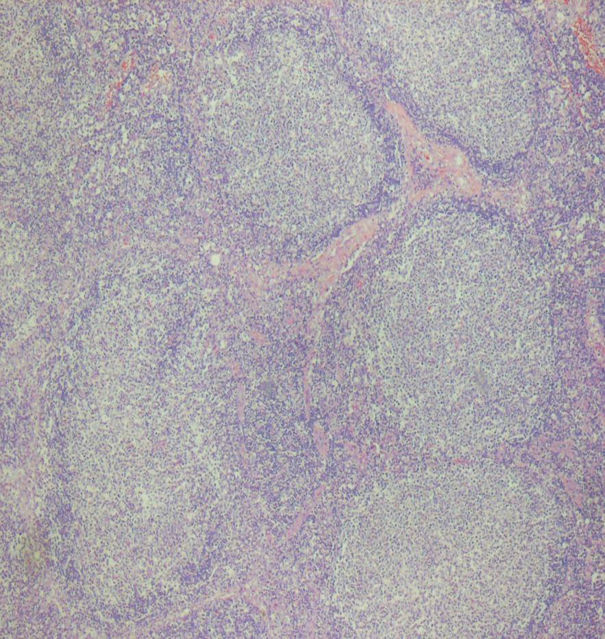 <p>reactive hyperplasia</p>