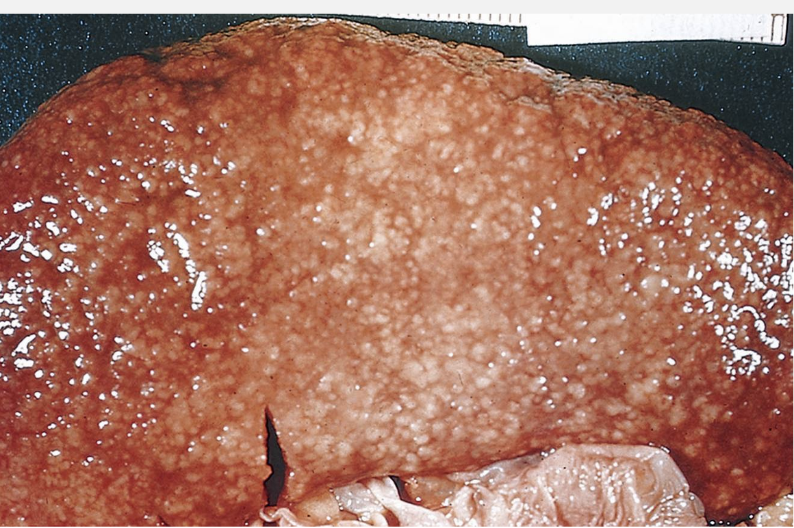 <p>What pathology is shown here?</p>