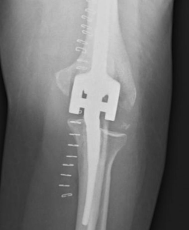 <p>Total Elbow Arthroplasty (TEA) Constrained vs Semiconstrained outcomes</p>