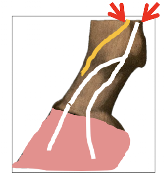 <ul><li><p>Aim to block and palmar metacarpal nerve and the palmar digital nerve </p><ul><li><p>= Block the entire digit (P1, P2 and P3) </p></li></ul></li></ul><ul><li><p>4 points of injections </p><ul><li><p>Medial palmar metacarpal nerve </p></li><li><p>Lateral palmar metacarpal nerve </p></li><li><p>Medial palmar nerve </p></li><li><p>Lateral palmar nerve </p></li></ul></li><li><p>Location: </p><ul><li><p>Distal end of the two splint bones (Named button)</p></li></ul></li></ul><p></p>