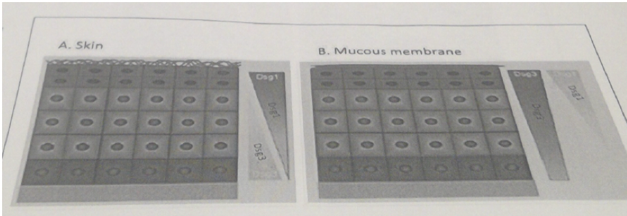 44\. The attachment contains a cartoon of the epidermis of skin (A) and the epithelial lining of the mucous membrane of the oral cavity (B). Both epithelia contain desmogein 1 (Dsg 1) and desmoglein 3 (Dsg3) with a distribution as indicated in the images. Patients with an autoimmune diseasewith autoantibodies that disrupt (knockout) the function of demoglein 1 will have the following phenotype