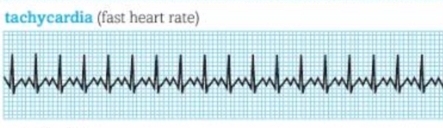 <p>fast Heart rate , Tachycardia </p>