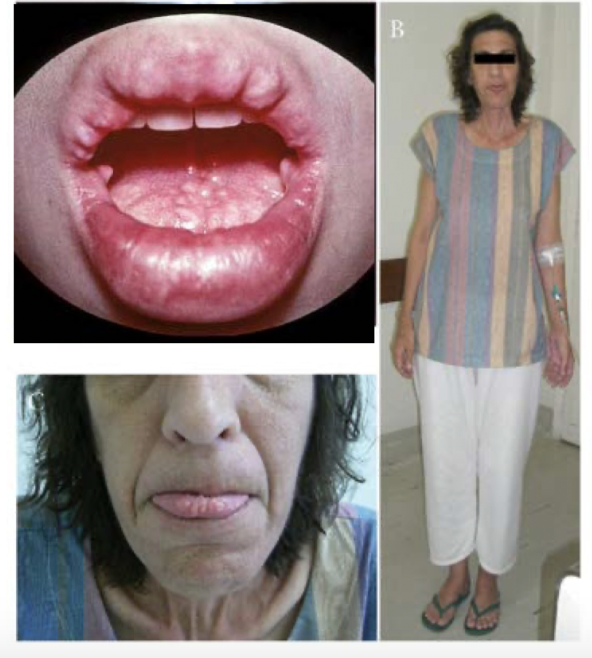 <p>multiple endocrine neoplasms with medullary thyroid carcinoma, pheochromocytomas, mucosal neuromas/ganglioneuromas, marfanoid habitus (long axial skeleton); RET gene mutation</p>