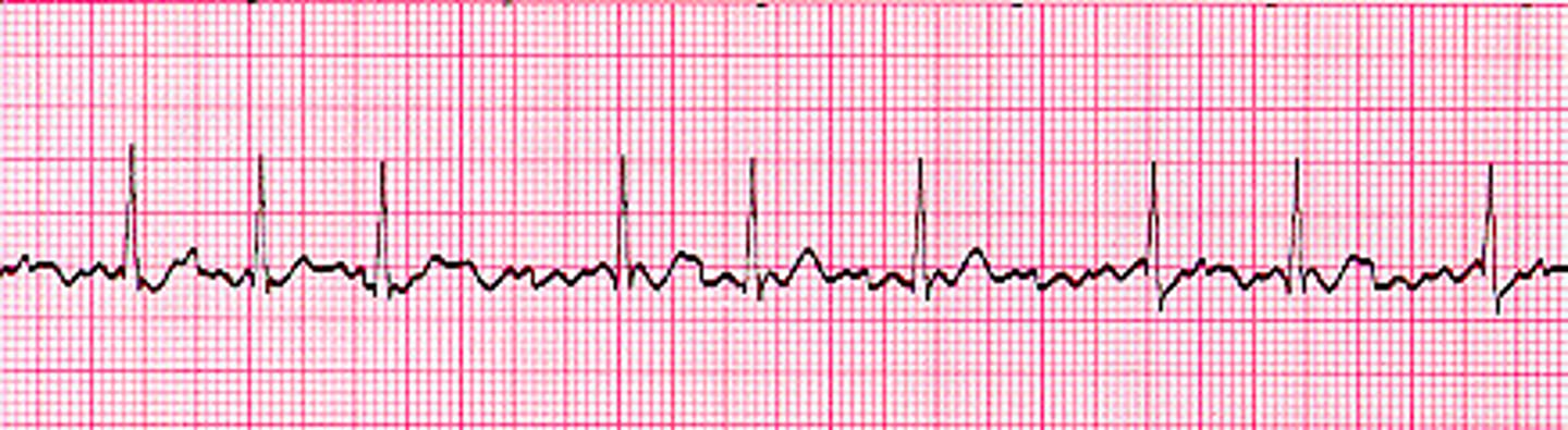 <p>Irregular QRS distance, no distinguishable P waves</p>
