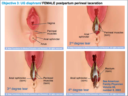 Damage is usually more pronounced in nulliparous women (tissues are firmer and more resistant)