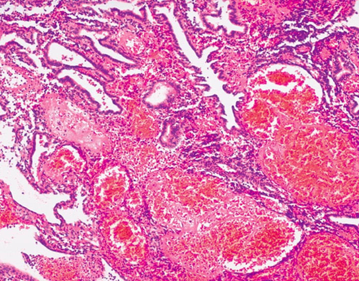 <p>-Shedding of the functional layer of the endometrium when no fertilization occurs</p><p>-Get rid of "trash" (leaves body)</p>