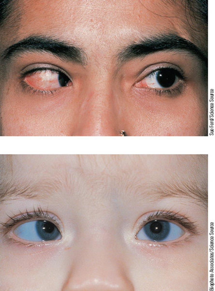<p>Informal term for strabismus resulting in reduced vision</p>