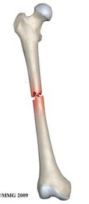 <p>what type of fracture is this?</p>