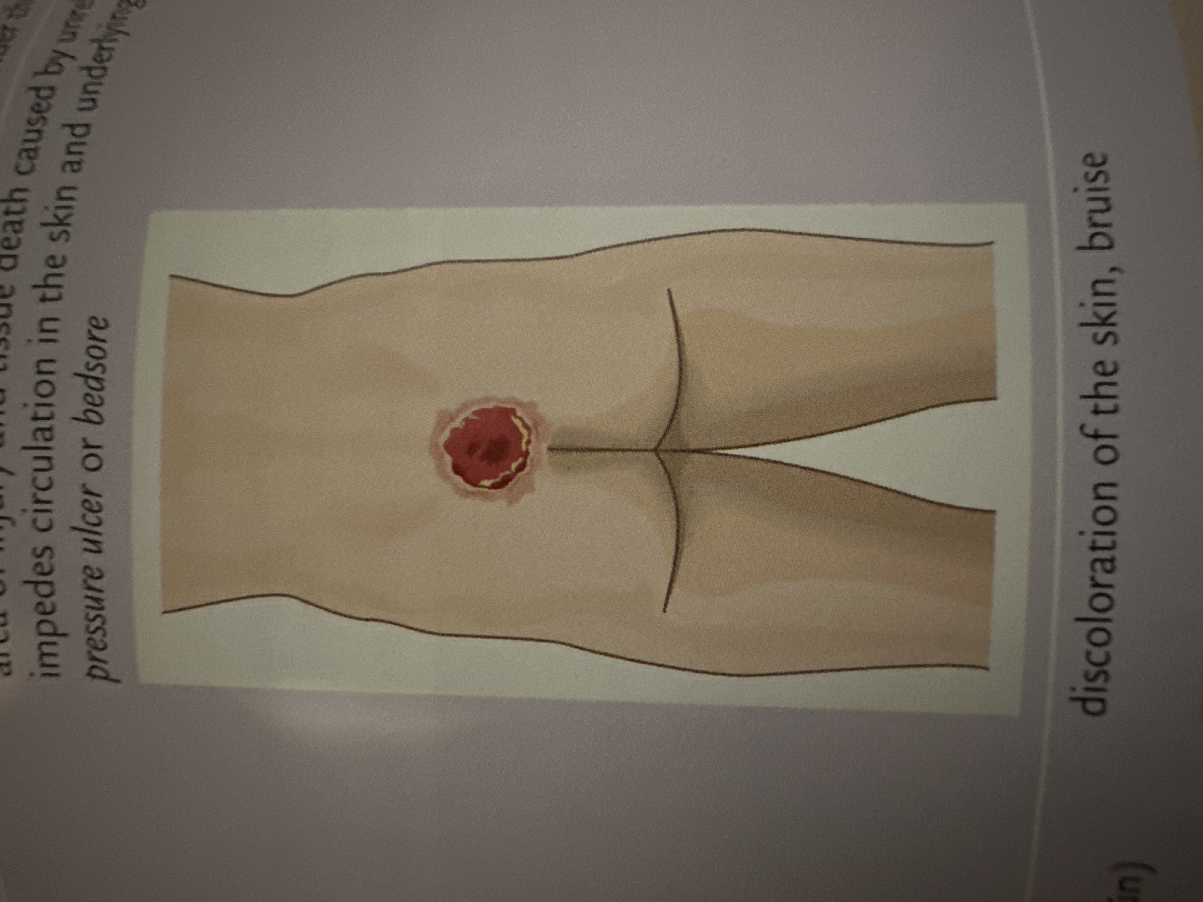 area of injury and tissue death caused by unrelieved pressure that impedes circulation in the skin and underlying tissues; also called pressure ulcer or bedsore

