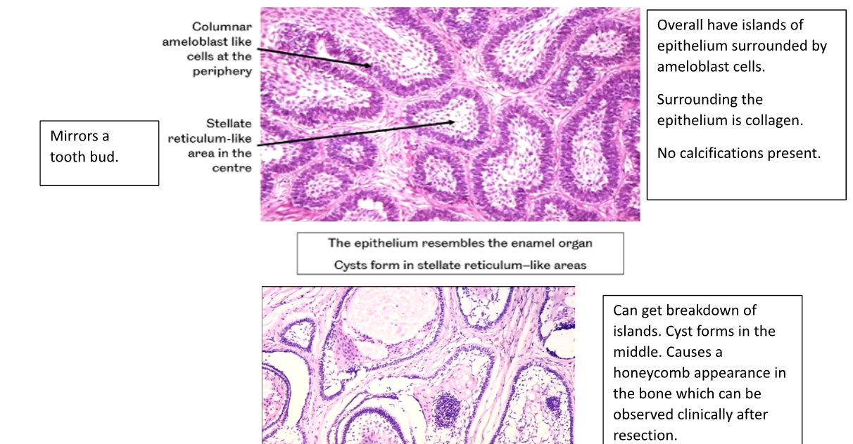 <p>1) Columnar Ameloblast Like Cells at the Periphery</p><p>2) Stellate Reticulum-Like area in the Centre</p><p>3) The Epithelium resembles the enamel organ, cysts form in the Stellate Reticulum like Areas.</p>