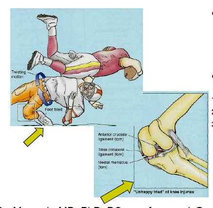 lateral blow to knee, MCL, medial meniscus, ACL
