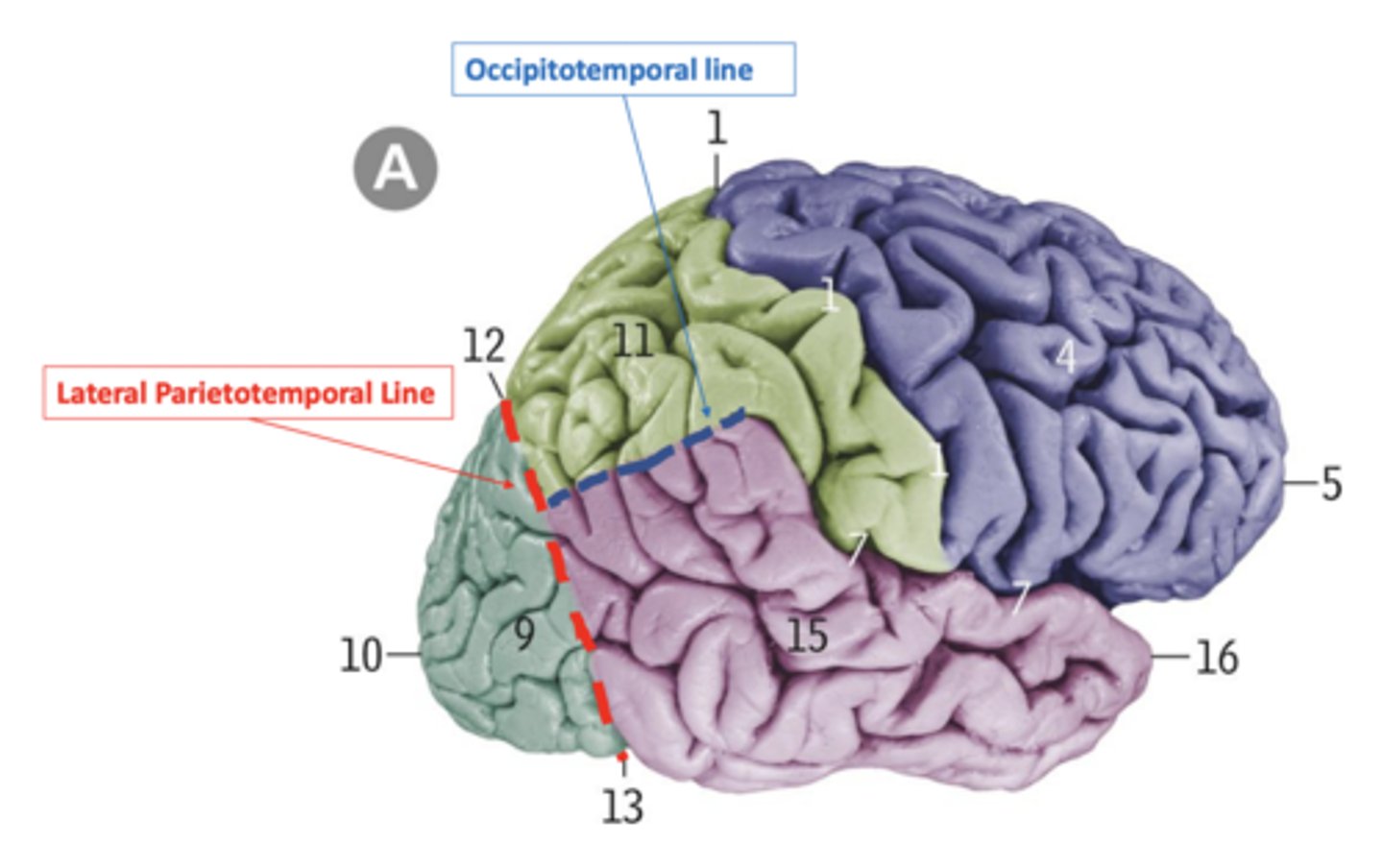 <p>imaginary line connecting the posterior margin of the Sylvian fissure with lateral parietotemporal line, separating the temporal and parietal lobes</p>