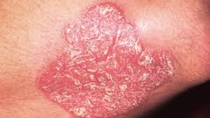 <p>A raised, flat topped lesion that is greater than 1 cm</p>