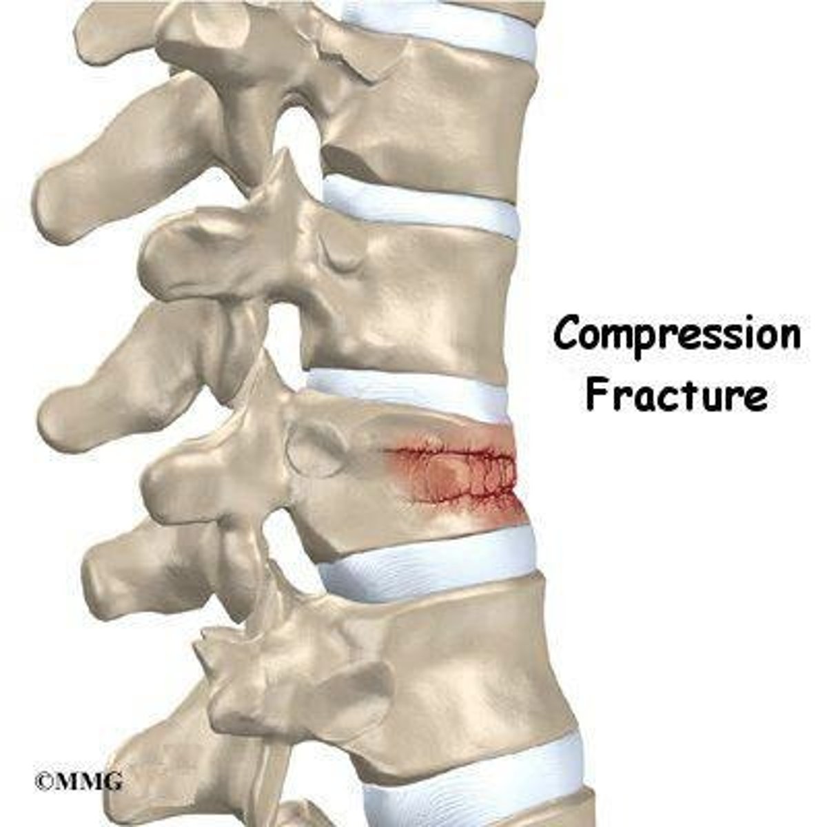 <p>Compressive downward load on the spine, typically in elderly and caused from something as simple as sneezing or sitting down hard, usually in the thoracolumbar area.</p>