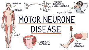 <p>What is Motor Neurone Disease (MND)?</p>